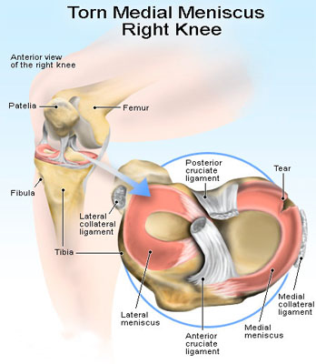 torn_meniscus